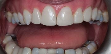 Post operative composite bonding