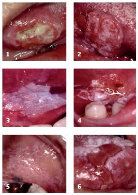 Oral cancer images